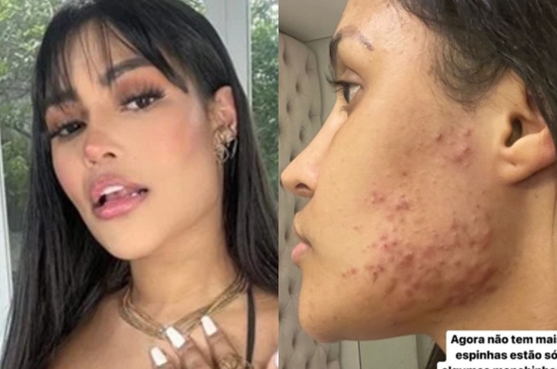 Ex-BBB Flay desabafa sobre chip hormonal para manter a beleza: “Destruiu a minha pele”