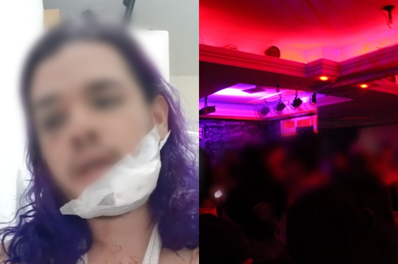 Durante festa, cabeleireiro tem rosto mordido após chamar estudante de direito de “mal-educado”, veja vídeo