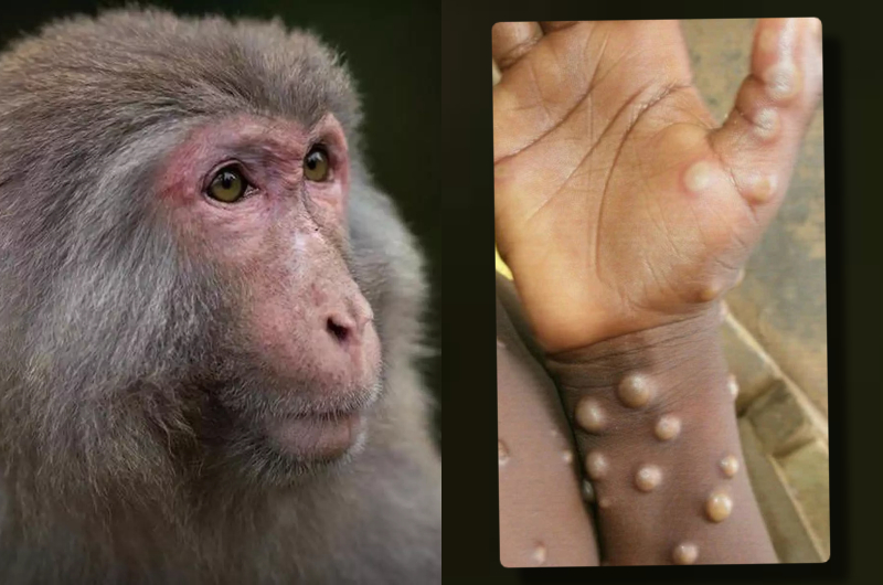 Varíola do Macaco é investigada em 6 estados brasileiros, saiba quais são