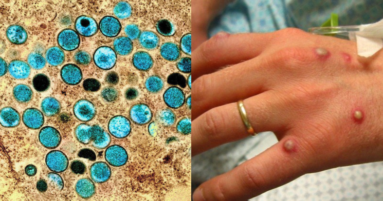 Varíola do macaco: com mais de 6.000 casos, OMS se reunirá para definir emergência da doença