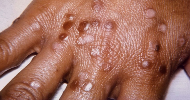 Urgente: Mais duas mulheres estão com suspeita de terem contraído varíola dos macacos no Amazonas