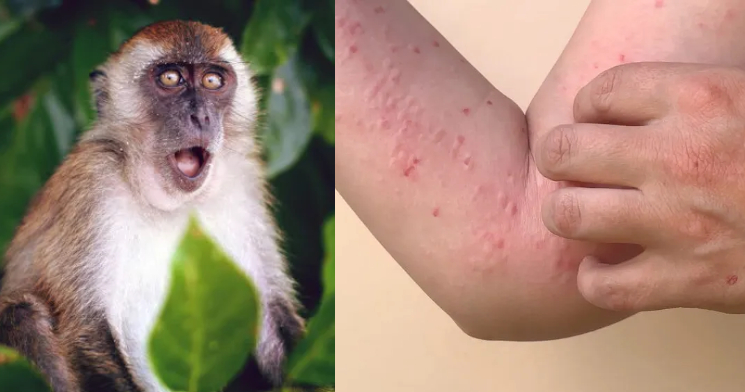 Com mais de mil casos, Brasil começa a tratar varíola dos macacos como surto