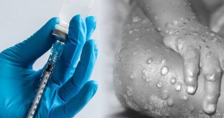 Com 696 casos confirmados, Brasil negocia compra de vacina contra varíola dos macacos