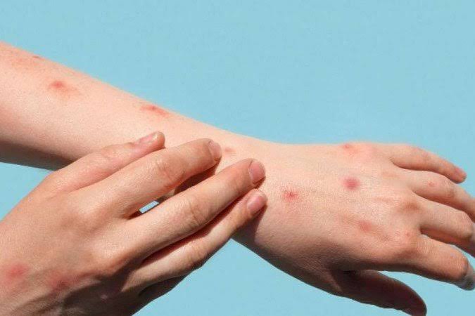 Alerta: segundo caso de varíola dos macacos é confirmado no Amazonas