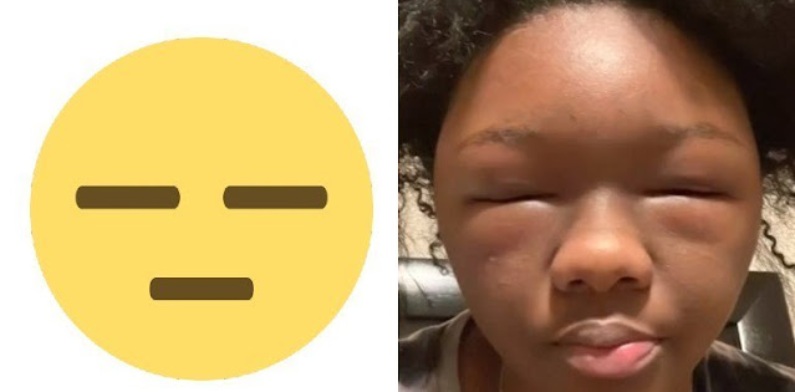 Jovem tenta “lacrar”com visual mas tem reação alérgica brutal a tintura de cabelo; “Parecia que eu era um emoji”