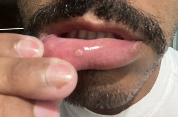 Homem confunde afta com varíola dos macacos; saiba a diferença