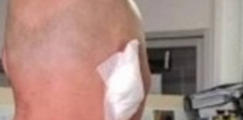 Bêbada, garota de programa ataca turista, arranca parte de orelha e depois engole; veja imagem