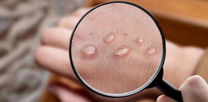 Quarto caso de varíola dos macacos é confirmado no Amazonas e deixa população em alerta