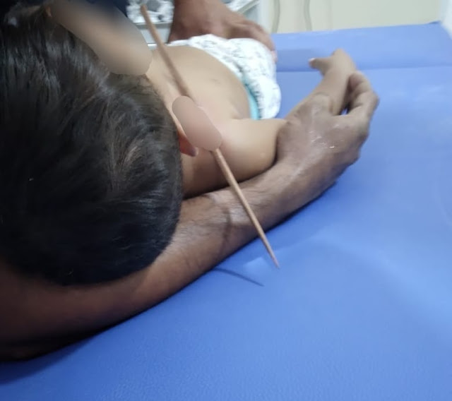 Espeto atravessa peito de bebê após acidente no interior do Amazonas