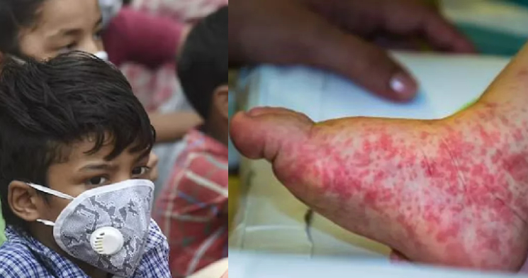 ‘Gripe do tomate’ preocupa após infectar rapidamente 82 crianças na Índia