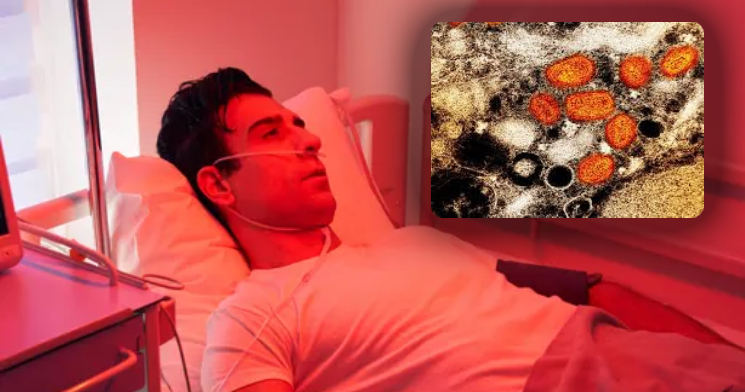 ‘Tudo ao mesmo tempo’: homem testa positivo para varíola dos macacos, HIV e Covid-19