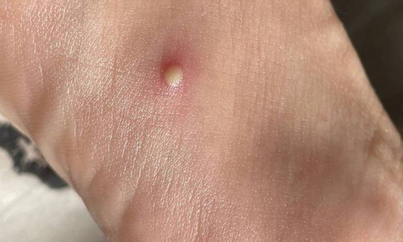 Alerta: Amazonas já registra 37 casos confirmados de varíola dos macacos