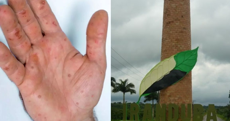 Caso de varíola dos macacos é confirmada em Iranduba e total vai para 111 no estado do Amazonas