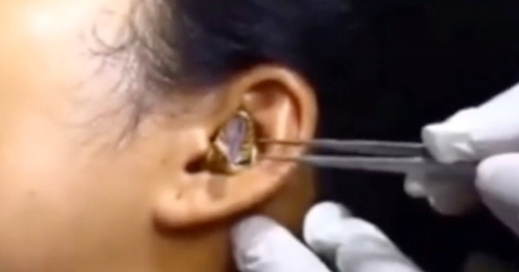 Médico mostra dificuldade para remover cobra que entrou no ouvido de mulher; veja vídeo