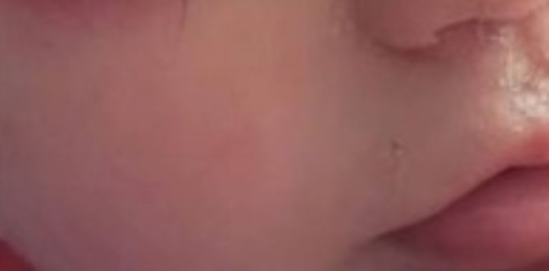 Menino é internado após cola espirrar em olho quando funcionária de berçário consertava unhas postiças