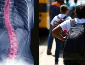 Volta às aulas e escoliose: médicos alertam perigo com o peso das mochilas das crianças