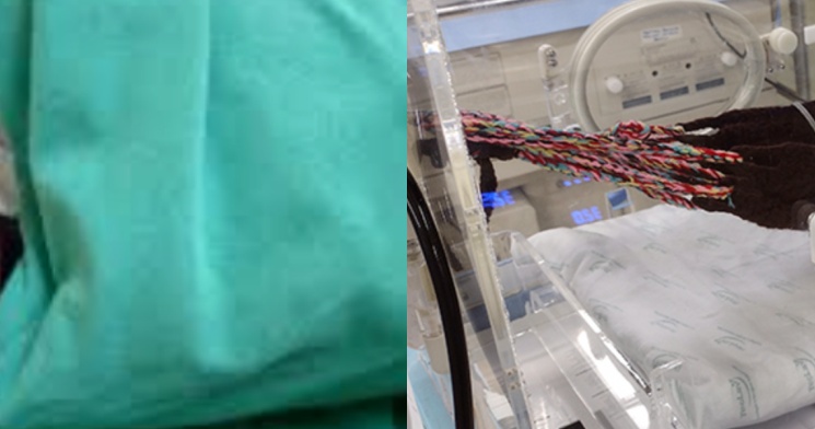 Caso surpreendente: médicos ficam chocados com bebê que nasceu com terceira mão nas costas; veja