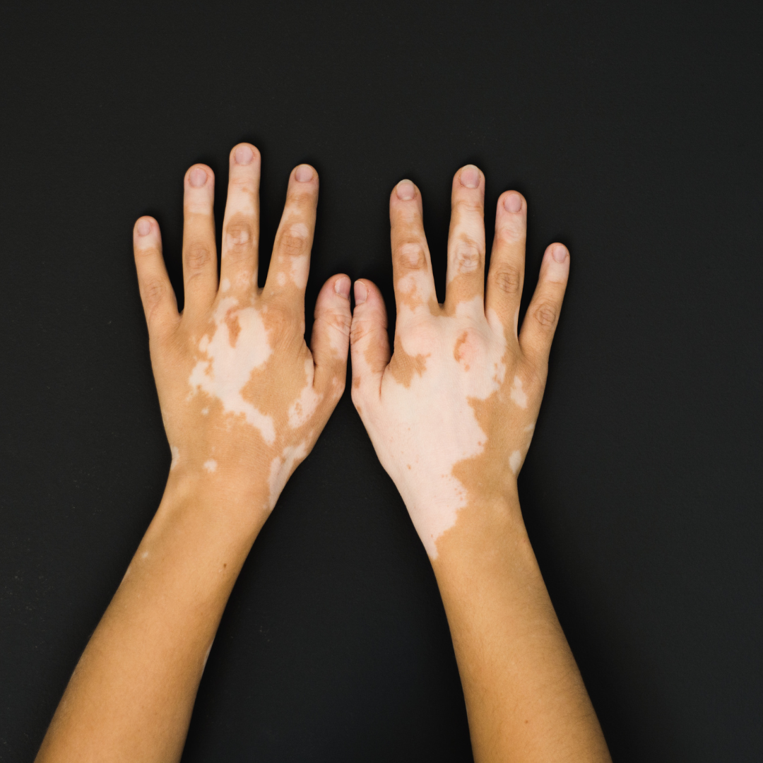 Vitiligo: SES-AM faz alerta para alto número de casos no estado