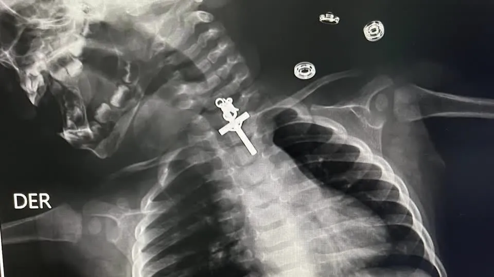 Crucifixo é detectado por meio de Raio-X na garganta de bebê