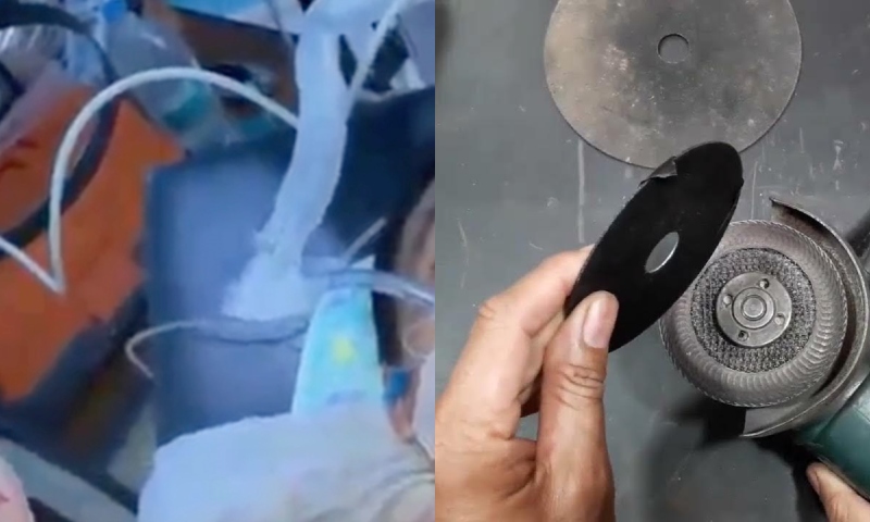 ‘Peão teimoso’: médico se espanta ao ver o que trabalhador fez com disco de corte; CENAS FORTES