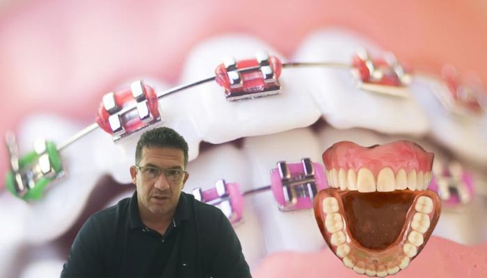Dentadura de ouro: contrato de R$ 700 mil deixa moradores de Manacapuru de boca aberta