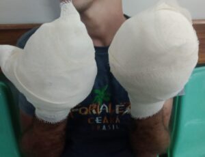 Homem torturado diz que teve os dedos torados por traficantes em Manaus