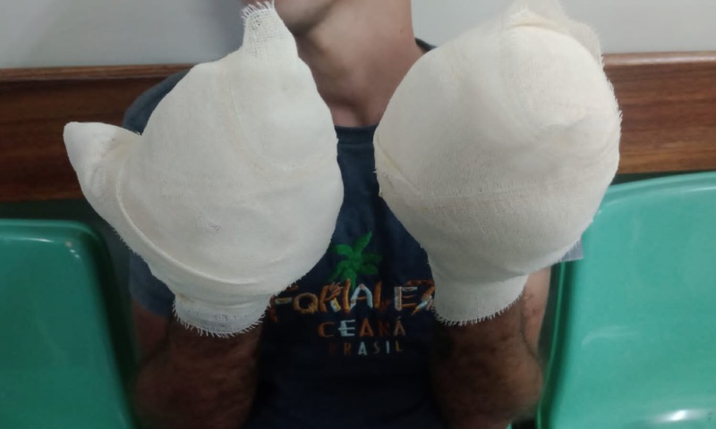 Homem tortur4do diz que teve os ded0s tor4dos por traficantes em Manaus