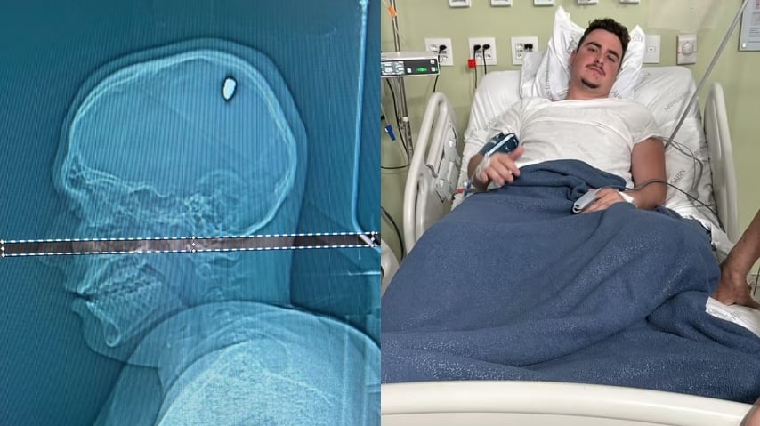 Estudante leva t1ro na c4beça e só descobre quatro dias depois: “achei que era pedrada”; veja imagem