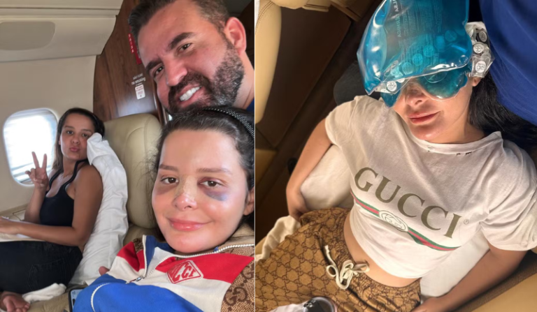 Maraísa explica acidente em que quebrou o nariz e mostra ferimentos