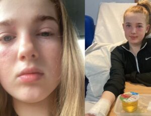 Menina de 13 anos quase fica cega após imitar tutorial de "skincare" do TikTok; veja