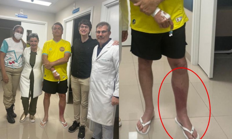 Saiba o que é Erisipela, infecção que afeta a perna de Jair Bolsonaro; veja