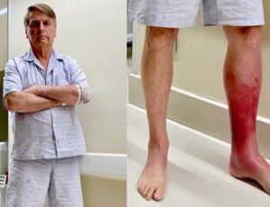 Perna de Bolsonaro piora com Erisipela e ex-presidente segue internado sem previsão de alta