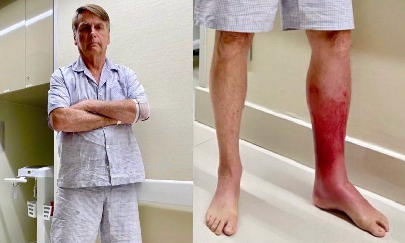 Perna de Bolsonaro piora com Erisipela e ex-presidente segue internado sem previsão de alta
