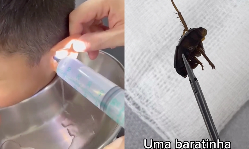 Veja momento que médico retira frutas e barata do ouvido de paciente