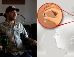 Paciente nº1 da Neuralink fala como funciona o chip implantado em seu cérebro; veja vídeo