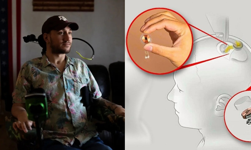 Paciente nº1 da Neuralink fala como funciona o chip implantado em seu cérebro; veja vídeo
