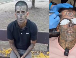 Homem se converte e passa por sessões de laser para remover tatuagens de caveira; veja vídeo