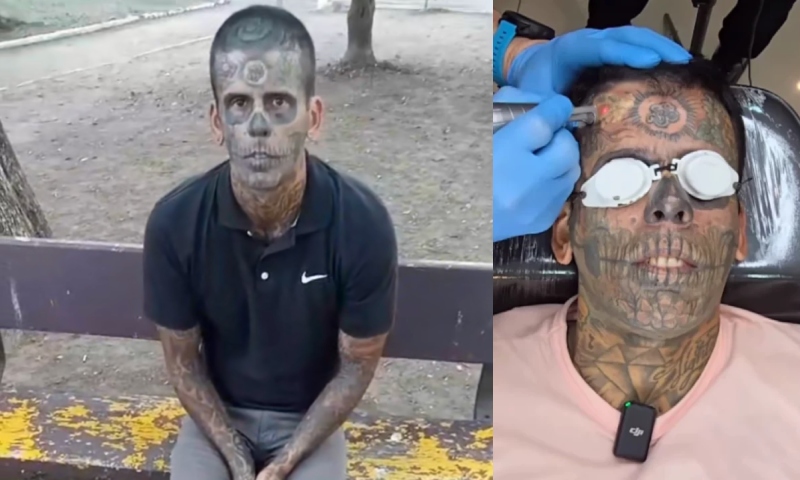 Homem se converte ao Evangelho e passa por sessões de laser para remover tatuagens; veja vídeo