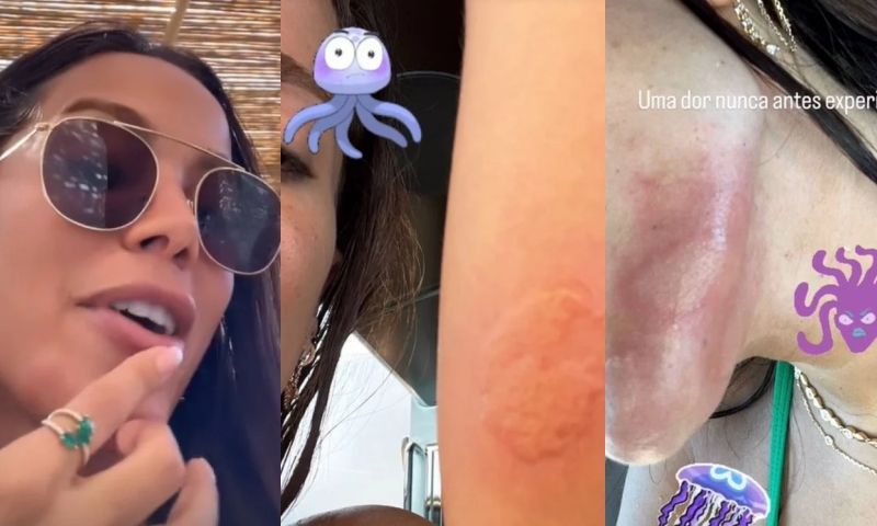 Anitta é queimada por água-viva e desabafa: ‘Uma dor que nunca senti na vida’; veja vídeo