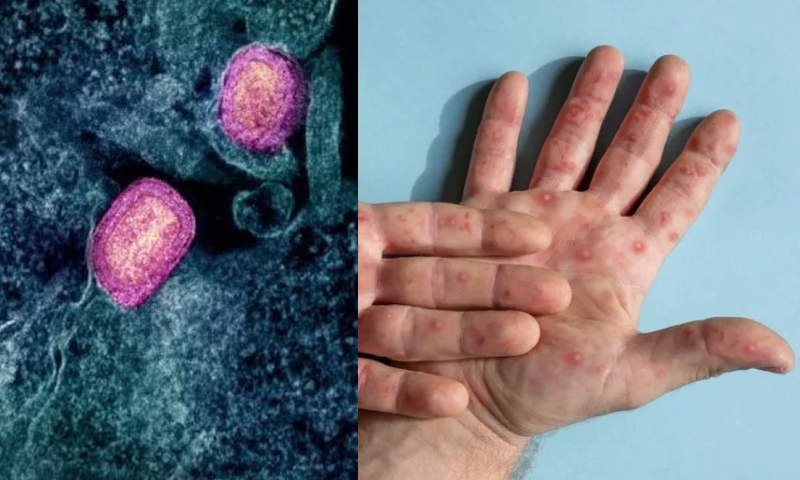 ‘Nova Pandemia?’: Surto de nova cepa da Varíola dos Macacos vira emergência Mundial de Saúde; veja vídeo