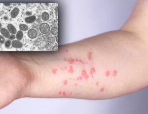 Alerta: Amazonas já registrou dois casos de monkeypox em 2024, diz FVS