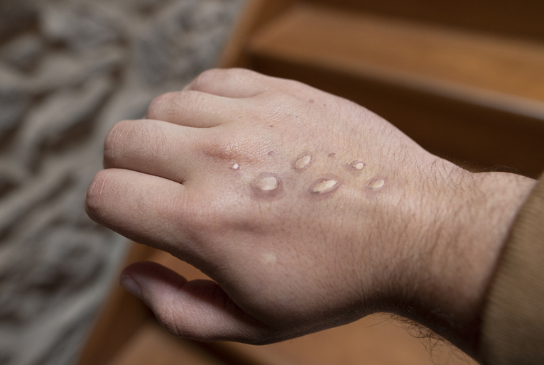 Monkeypox: OMS faz recomendações temporárias para situações de surto da doença