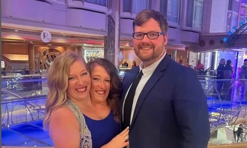 Gêmeas siamesas unidas pelo tórax anunciam gravidez