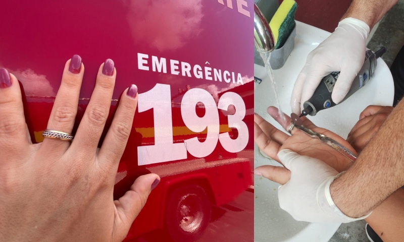 “Anel entalado”: Em Manaus, a cada ano, mais de 400 pessoas são socorridas com anéis presos nos dedos