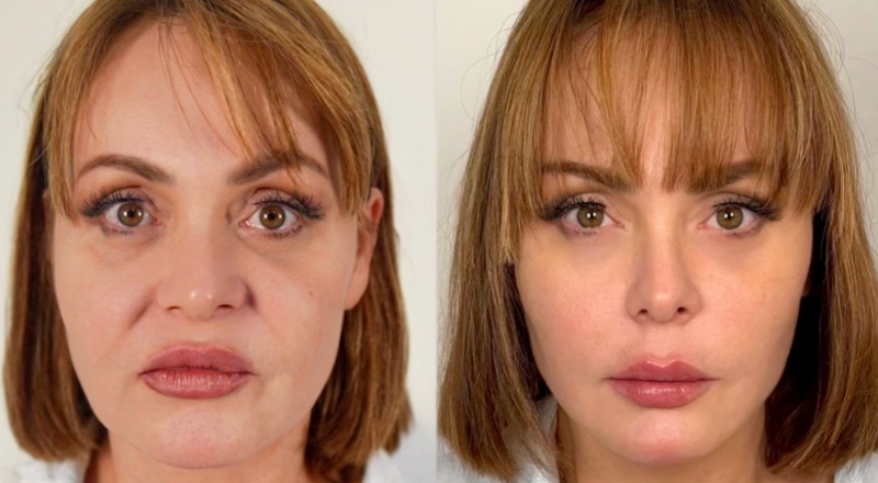 Gaby Spanic, a “Usurpadora”, faz harmonização facial e mostra resultado; veja vídeo