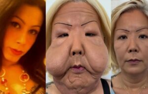 Juju do Pix inicia reconstrução facial e médico revela como ela pode ficar ao final do tratamento; veja