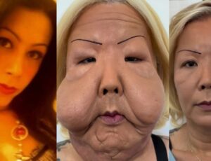 Juju do Pix inicia reconstrução facial e médico revela como ela pode ficar ao final do tratamento; veja