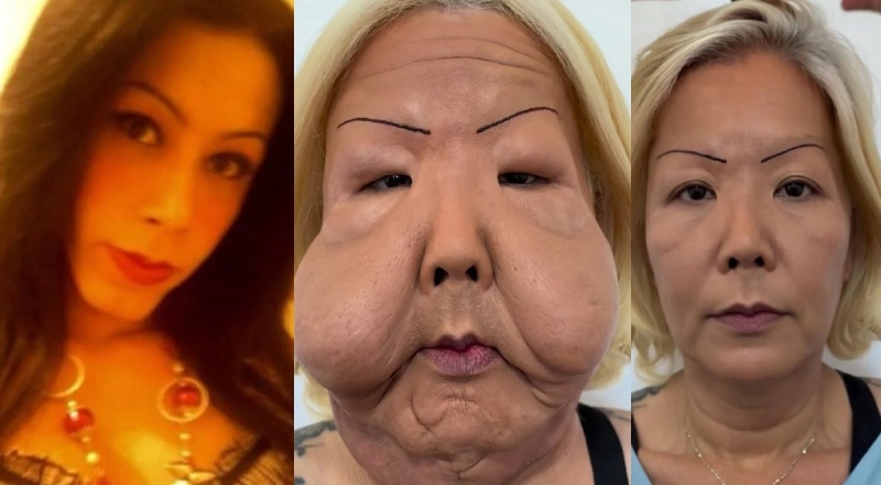 Juju do Pix inicia reconstrução facial e médico revela como ela pode ficar ao final do tratamento; veja vídeo