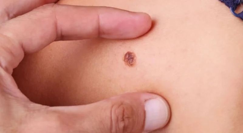 Prefeitura de Manaus reforça importância da prevenção do câncer de pele e orienta sobre sintomas e cuidados