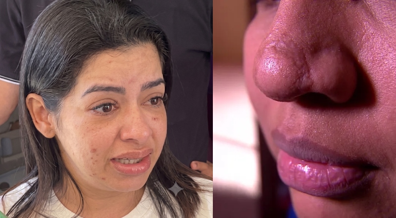 Falsa biomédica é presa de novo em Manaus e minimiza necrose em cliente: “Ela denuncia porque o resultado não agrada”; vídeo